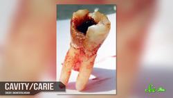 Why Do I Have to Brush My Teeth? Instructional Video