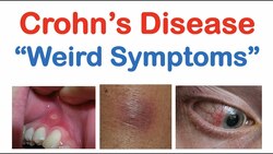 Weird Symptoms of Crohn’s Disease | Atypical Clinical Features | Skin, Mouth, Joints, Organ Systems Instructional Video