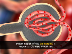 Disorders of Excretory System Instructional Video