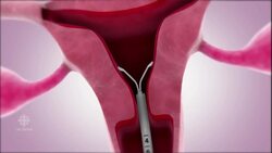 Pediatric Society calls for free birth control for Canadian youth News Clip