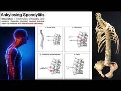 Ankylosing Spondylitis | Mechanism, Risk Factors, & Signs/Symptoms Instructional Video