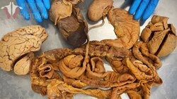 Do You Really Need Them? Organs You Can Live Without Instructional Video