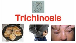 Trichinosis (Pork Parasite) | Pathophysiology, Signs & Symptoms, Diagnosis, Treatment Instructional Video
