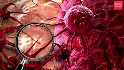 Key symptoms of lung cancer you must pay attention to News Clip