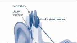 Cochlear Implants: Determining if a cochlear implant is needed Instructional Video