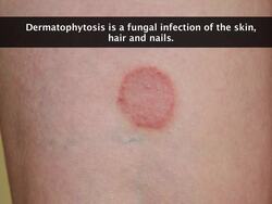 Common Fungal Diseases in Humans Instructional Video