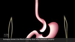 Lisa Marie Presley died of a bowel obstruction, a complication of bariatric surgery, autopsy shows News Clip