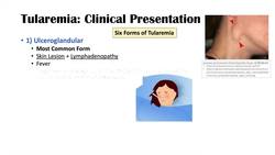 Tularemia (Rabbit Fever) | Causes, Pathogenesis, Forms, Symptoms, Diagnosis, Treatment Instructional Video