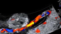 Belly Buttons: From Umbilical Cords to Fashion Statements Instructional Video