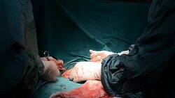 Hysterectomy Surgery Stock Footage