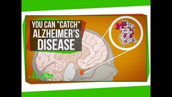 You Can "Catch" Alzheimer's Disease Instructional Video
