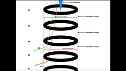 Relation Between Disc Herniation & Compressed Nerve Root Levels Instructional Video
