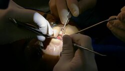 Removal of nasal septum during actual surgical procedure of nasal septum deviation correction and rhinoplasty. Female patient under general anesthesia. Stock Footage