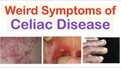 Weird Symptoms of Celiac Disease | Atypical Clinical Features Instructional Video