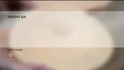 More cases of cancer linked to textured breast implants News Clip