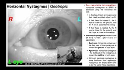 Nystagmus EXPLAINED 👀 | Visualizing & Interpretation Instructional Video