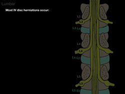 Spine Nerve Impingement Instructional Video