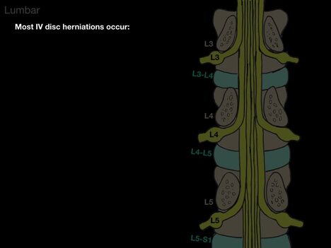 Spine Nerve Impingement