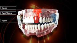 Dental Avulsion - First Aid Response for a Knocked-out Tooth Instructional Video