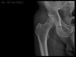 Anatomy of Hip X-rays Instructional Video