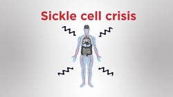 Sickle cell anaemia Instructional Video