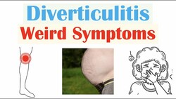 Weird Symptoms of Diverticulitis | Atypical Clinical Features of Diverticulitis Instructional Video