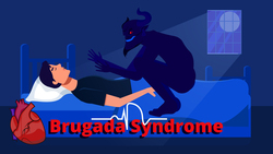 Brugada Syndrome: ECG, Symptoms, Physiology & Treatments Instructional Video