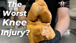 The Worst Possible Direction for Knee Joint: Hyperextension Instructional Video