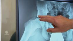 Risk for single-sport kids supported by medical evidence News Clip