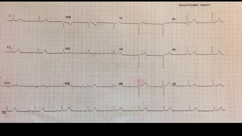 Thumbnail for ECG1 - rates and durations