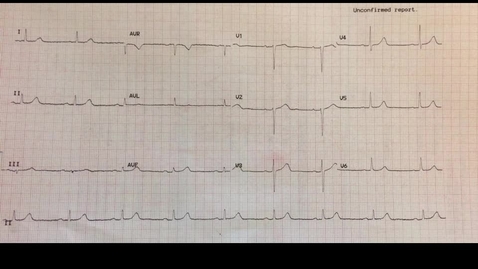 Thumbnail for entry ECG1 - rates and durations