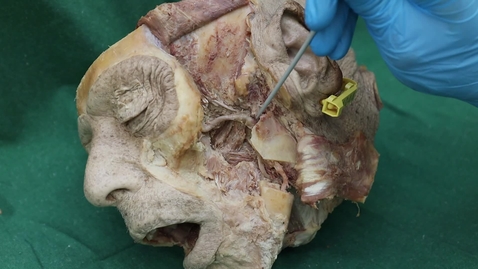 Thumbnail for entry Temporomandibular cartilagenous disc