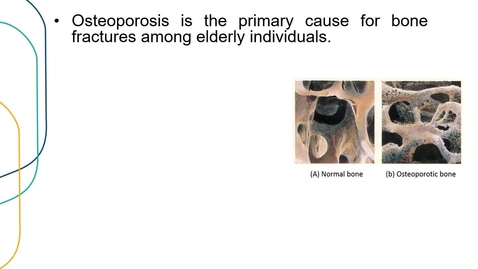 Thumbnail for Application 1 workflow: Prediction of osteoporotic fractures 