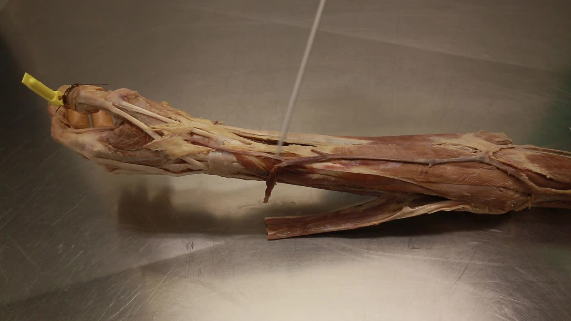 30 D Anatomical Snuff Box The University Of Sheffield Kaltura Digital Media Hub It is a triangular depression seen on the lateral aspect of dorsum of hand when the thumb is extended. 30 d anatomical snuff box the