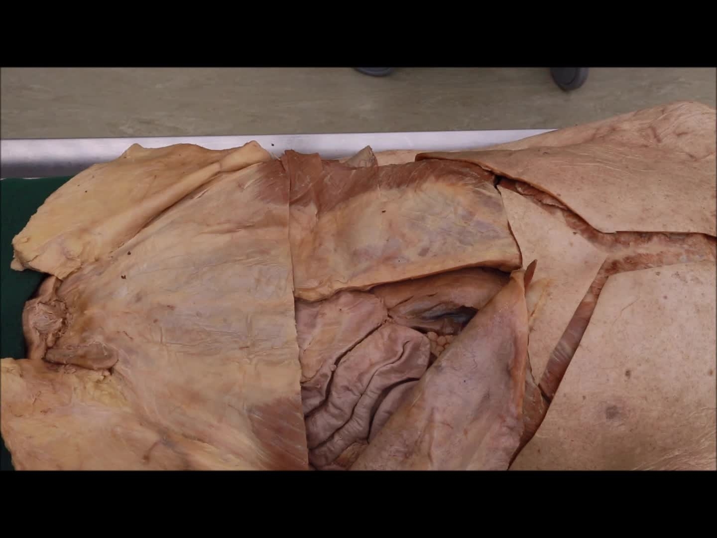 10 B Ligamentum Teres And Falciform The University Of Sheffield Kaltura Digital Media Hub