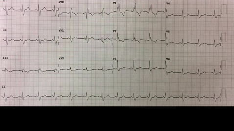 Thumbnail for entry ECG 2 - the QRS complex