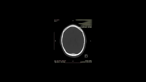 Thumbnail for Inside Perspective - life saving micro camera