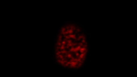 Thumbnail for Ovarian cancer cell visualised using STED super-resolution microscopy