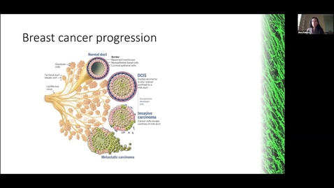 Thumbnail for entry Breast cancer cells using unconventional nutrient sources to sustain their growth