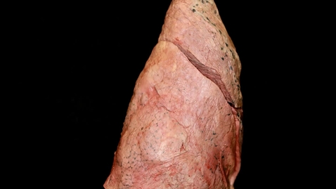 Thumbnail for Lung Right