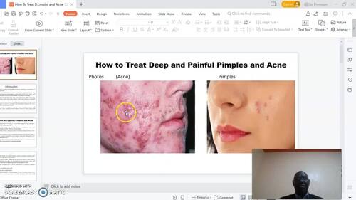 Preview of How to Treat Deep and Painful Pimples and Acne