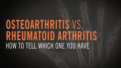 Arthritis Flare-Ups: What a Flare Feels Like and How to Treat It