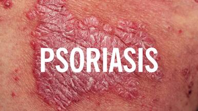 Biologic Therapy For Psoriasis Raleigh Nc