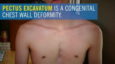 Can I get a big chest if I have Pectus Excavatum? : r/Fitness