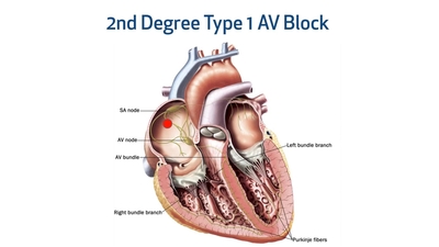 ECG Interpretation: Distinguishing AV Blocks - Welcome to Houston ...